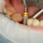 Dental Implants