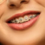 Orthodontic Braces