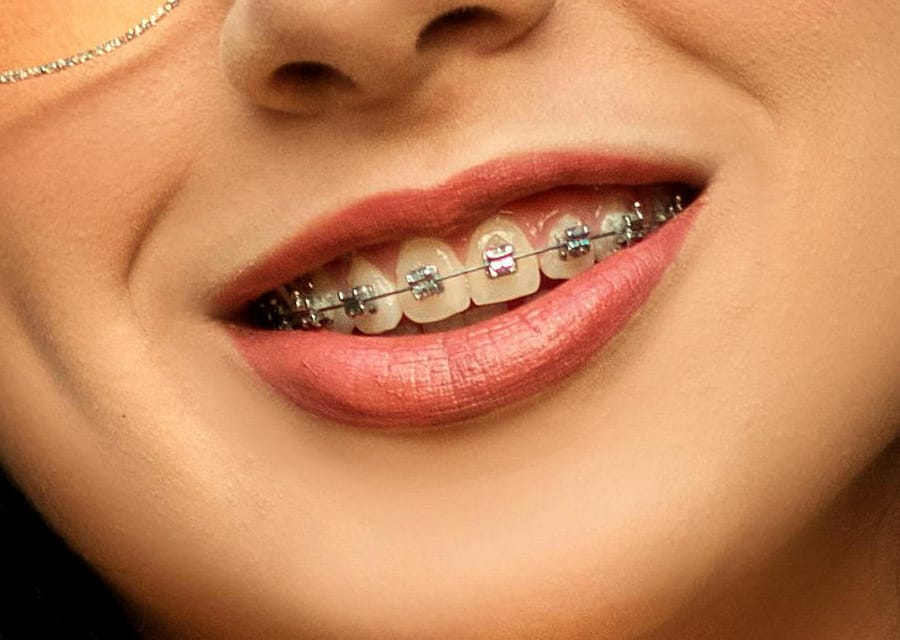 Orthodontic Braces