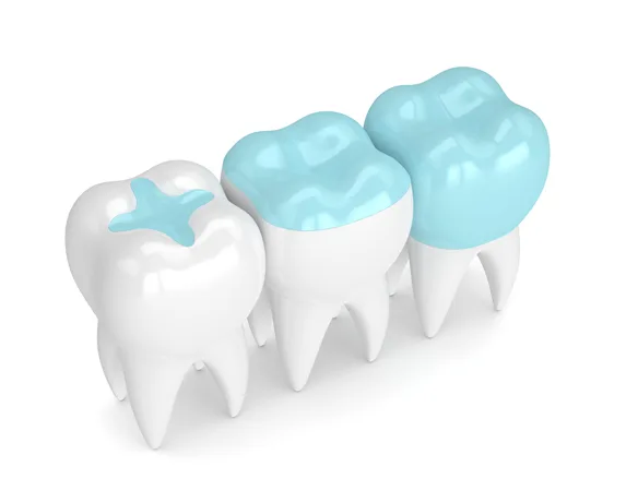 Inlays and Onlays in Tirunelveli at Sukumar Dental Clinic