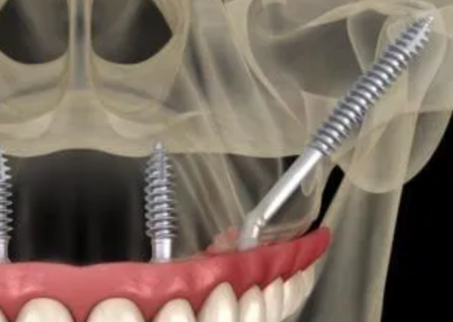 zygomatic and pterygoid implants