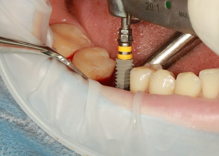 Dental Implants