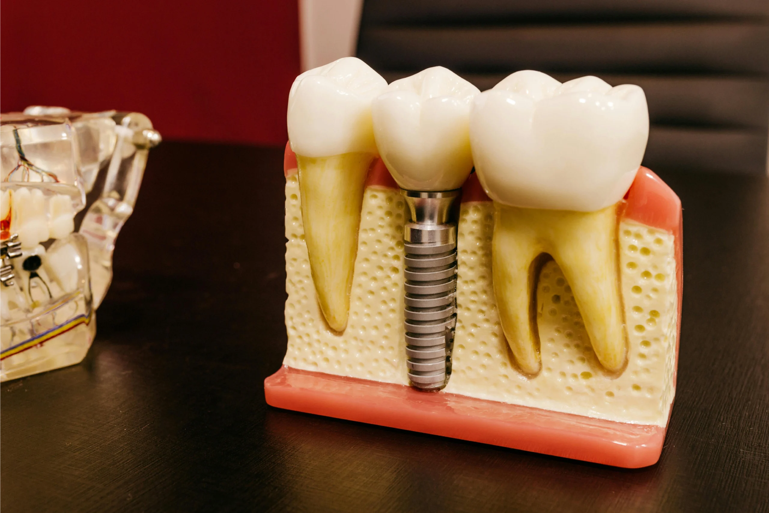 Dental Implants