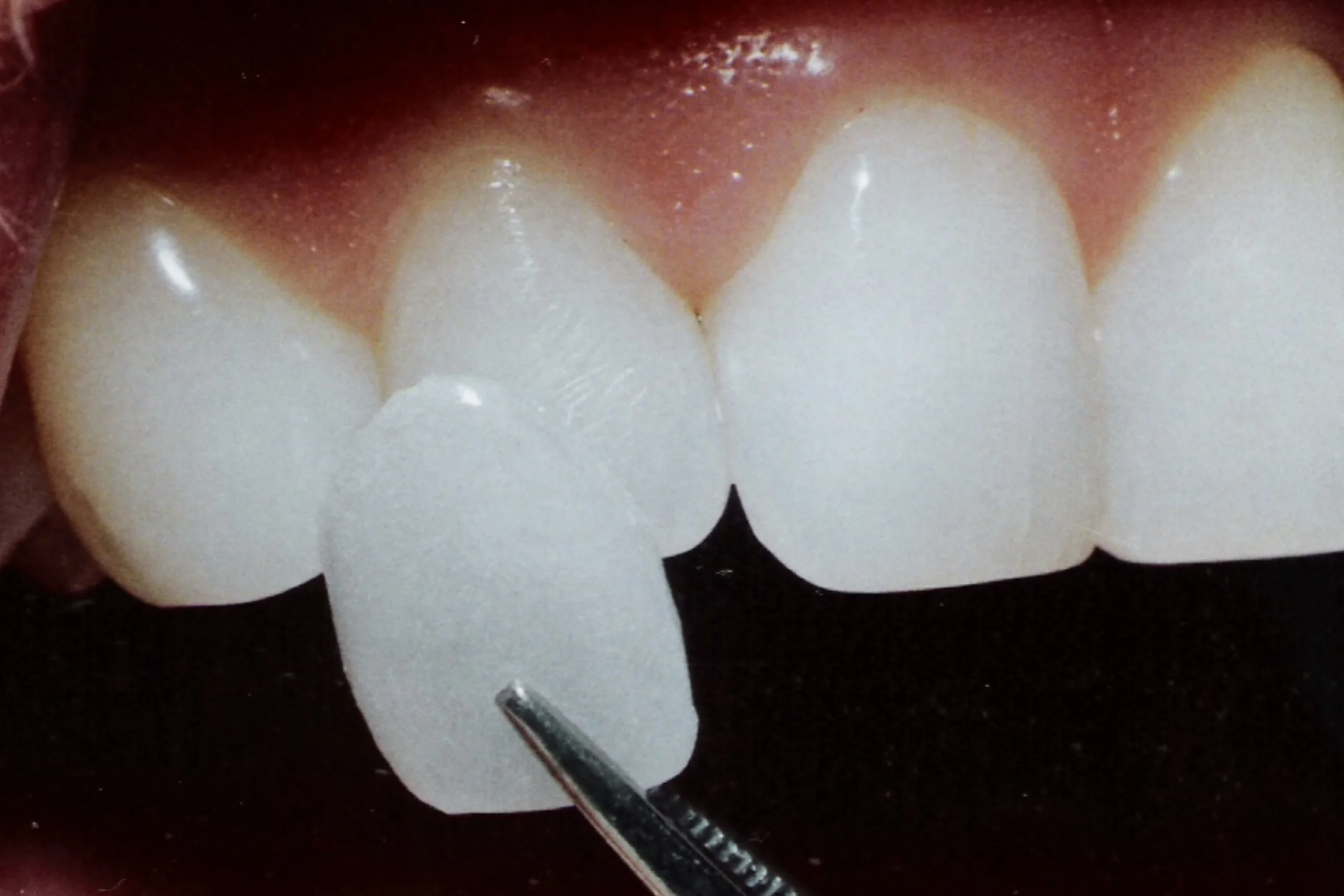 Dental Veneers and Dental Laminates