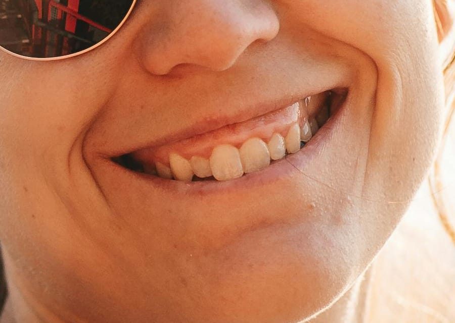 Gummy Smiles Gummy Smiles